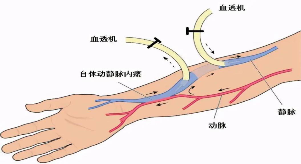 科普|血液透析患者日常內瘺的維護妙招